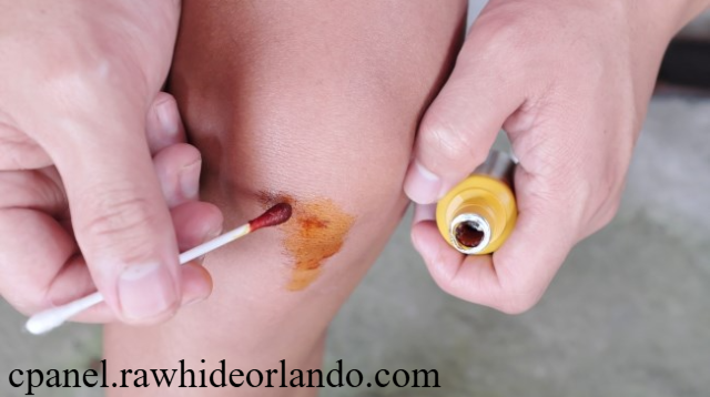 Perawatan Luka yang Benar Menjaga Luka Agar Cepat Sembuh